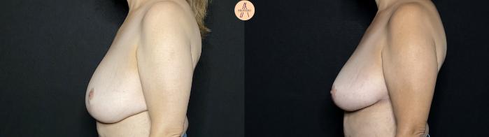 Before & After Breast Lift Case 268 Left Side View in San Antonio, Texas