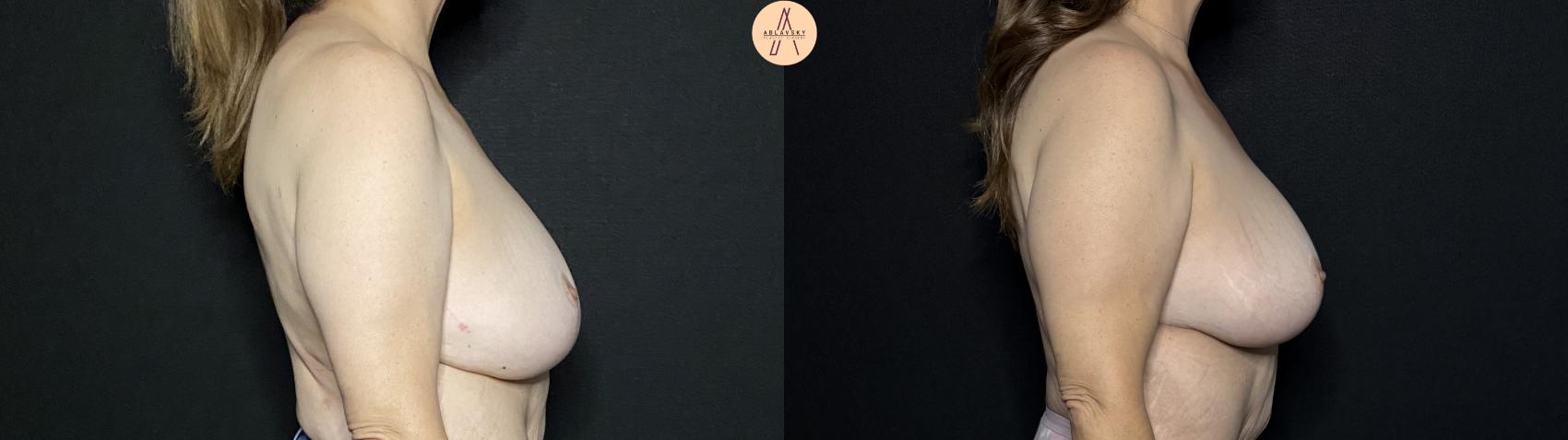Before & After Breast Lift Case 268 Right Side View in San Antonio, Texas