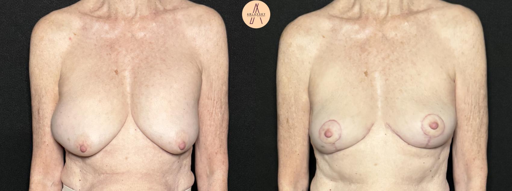 Before & After Breast Lift Case 292 Front View in San Antonio, Texas