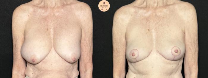 Before & After Breast Lift Case 292 Front View in San Antonio, Texas