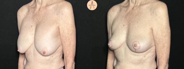 Before & After Breast Lift Case 292 Left Oblique View in San Antonio, Texas