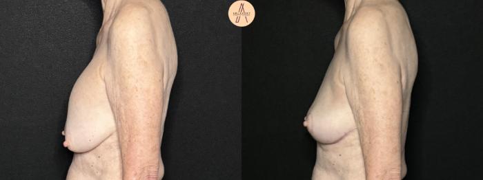 Before & After Breast Lift Case 292 Left Side View in San Antonio, Texas