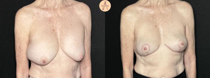 Before & After Breast Lift Case 292 Right Oblique View in San Antonio, Texas