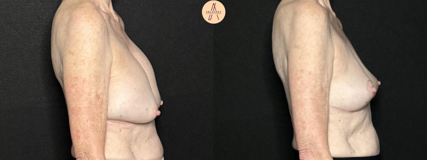 Before & After Breast Lift Case 292 Right Side View in San Antonio, Texas