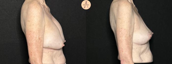 Before & After Breast Lift Case 292 Right Side View in San Antonio, Texas