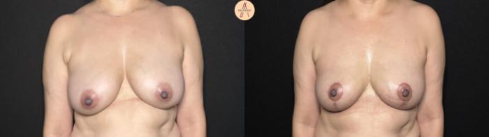 Before & After Breast Lift Case 303 Front View in San Antonio, Texas