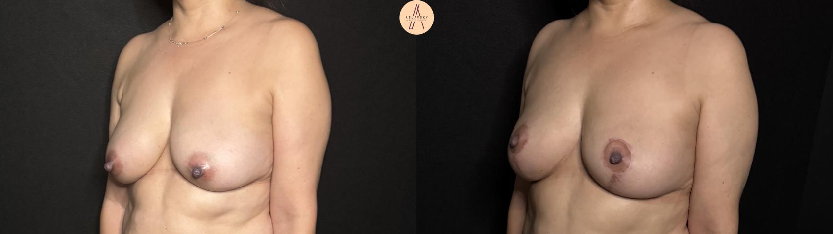 Before & After Breast Lift Case 303 Left Oblique View in San Antonio, Texas