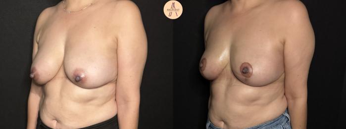 Before & After Breast Lift Case 303 Left Oblique View in San Antonio, Texas