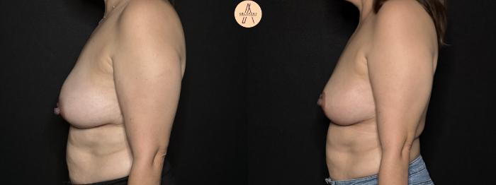 Before & After Breast Lift Case 303 Left Side View in San Antonio, Texas