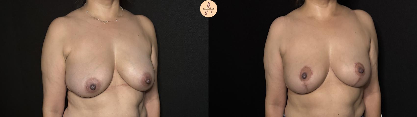 Before & After Breast Lift Case 303 Right Oblique View in San Antonio, Texas