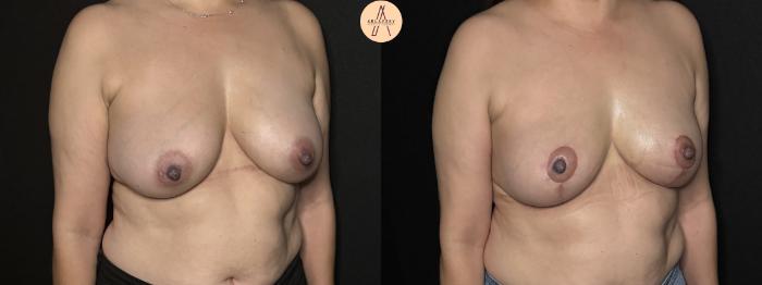 Before & After Breast Lift Case 303 Right Oblique View in San Antonio, Texas