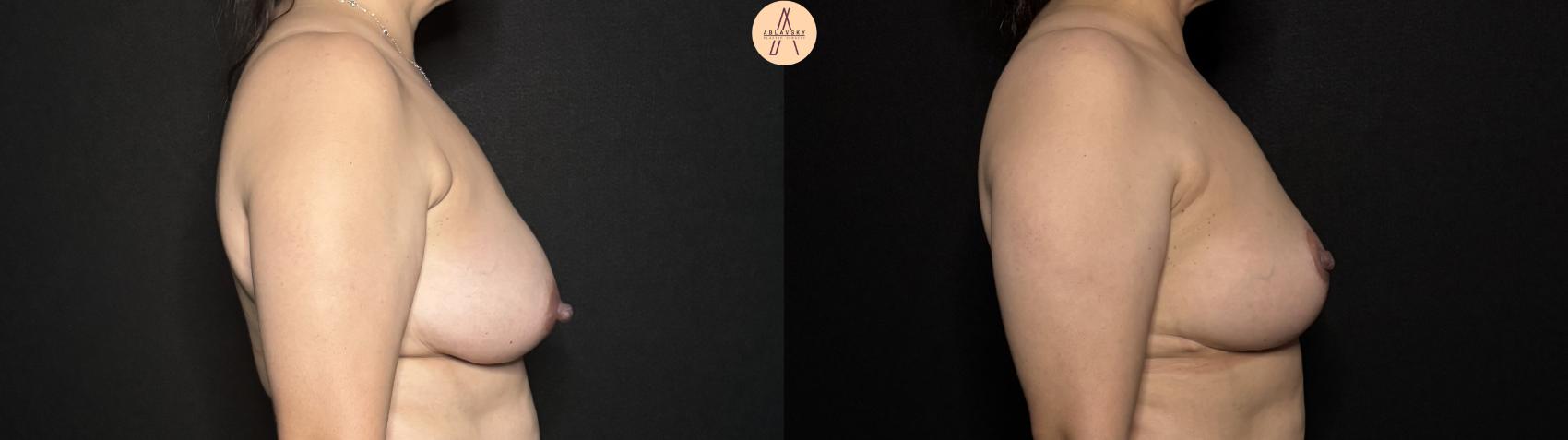 Before & After Breast Lift Case 303 Right Side View in San Antonio, Texas