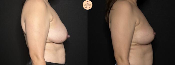 Before & After Breast Lift Case 303 Right Side View in San Antonio, Texas