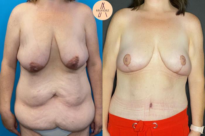 Before & After Breast Lift Case 31 Front View in San Antonio, Texas