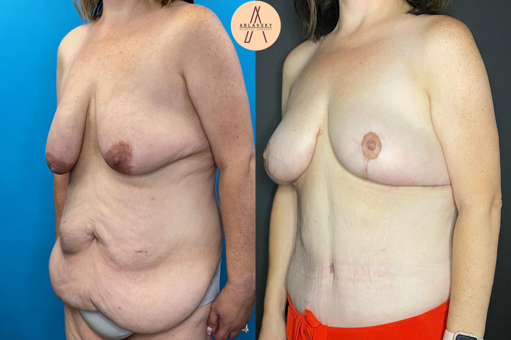 Before & After Breast Lift Case 31 Left Oblique View in San Antonio, Texas