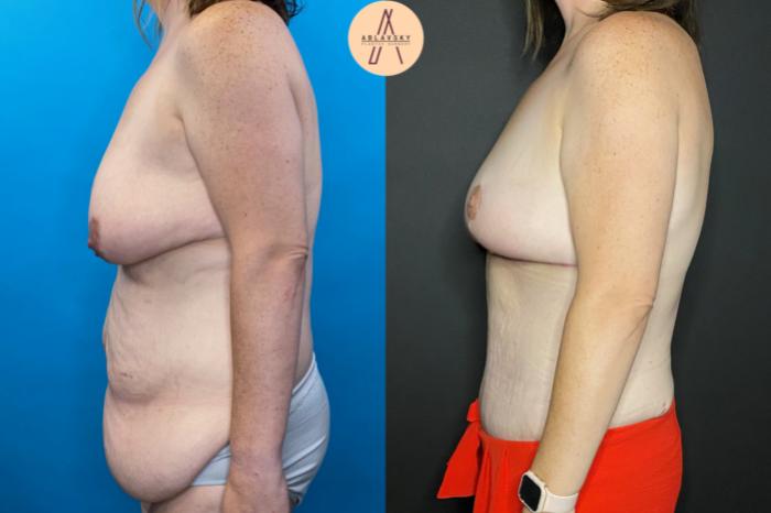 Before & After Breast Lift Case 31 Left Side View in San Antonio, Texas