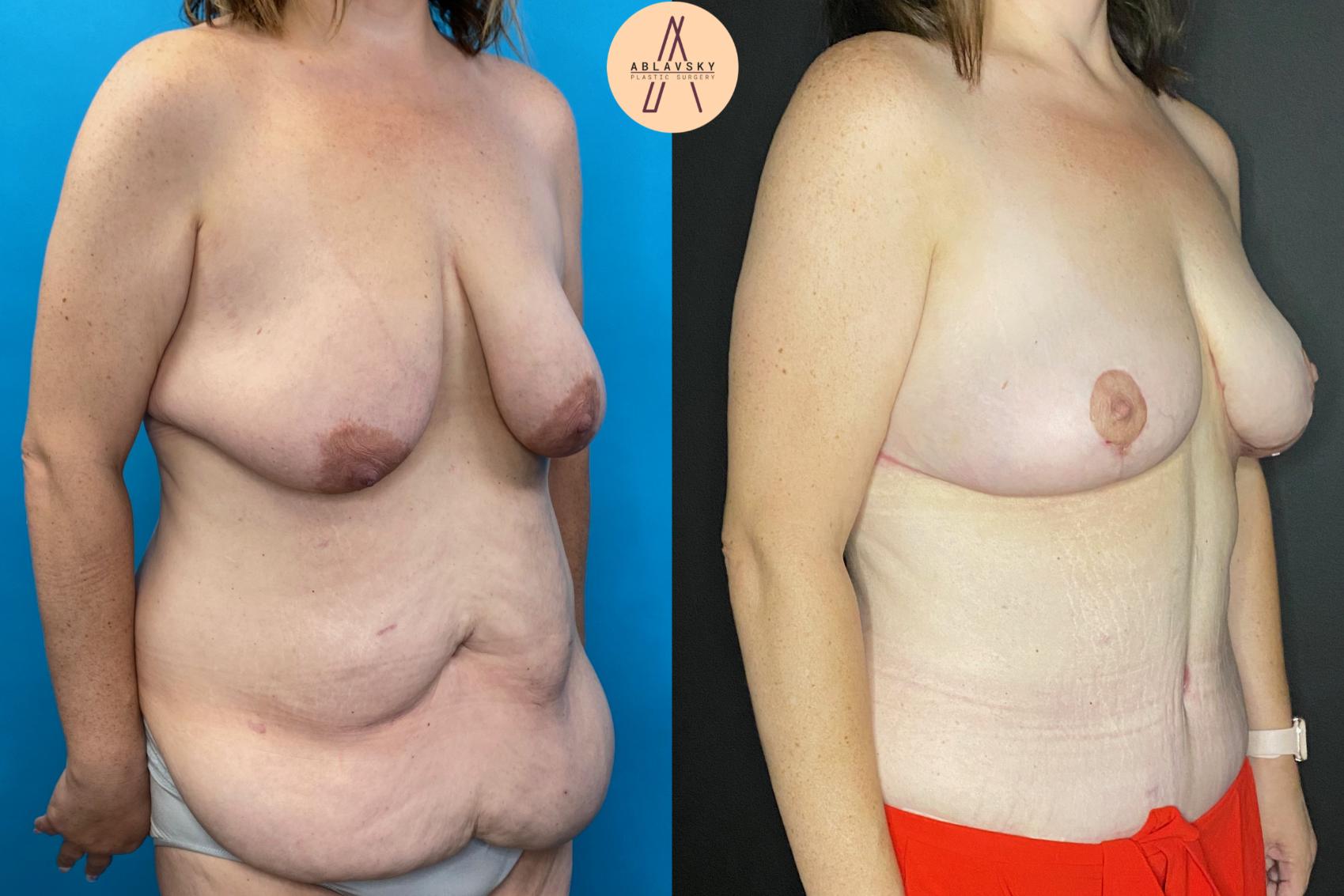 Before & After Breast Lift Case 31 Right Oblique View in San Antonio, Texas