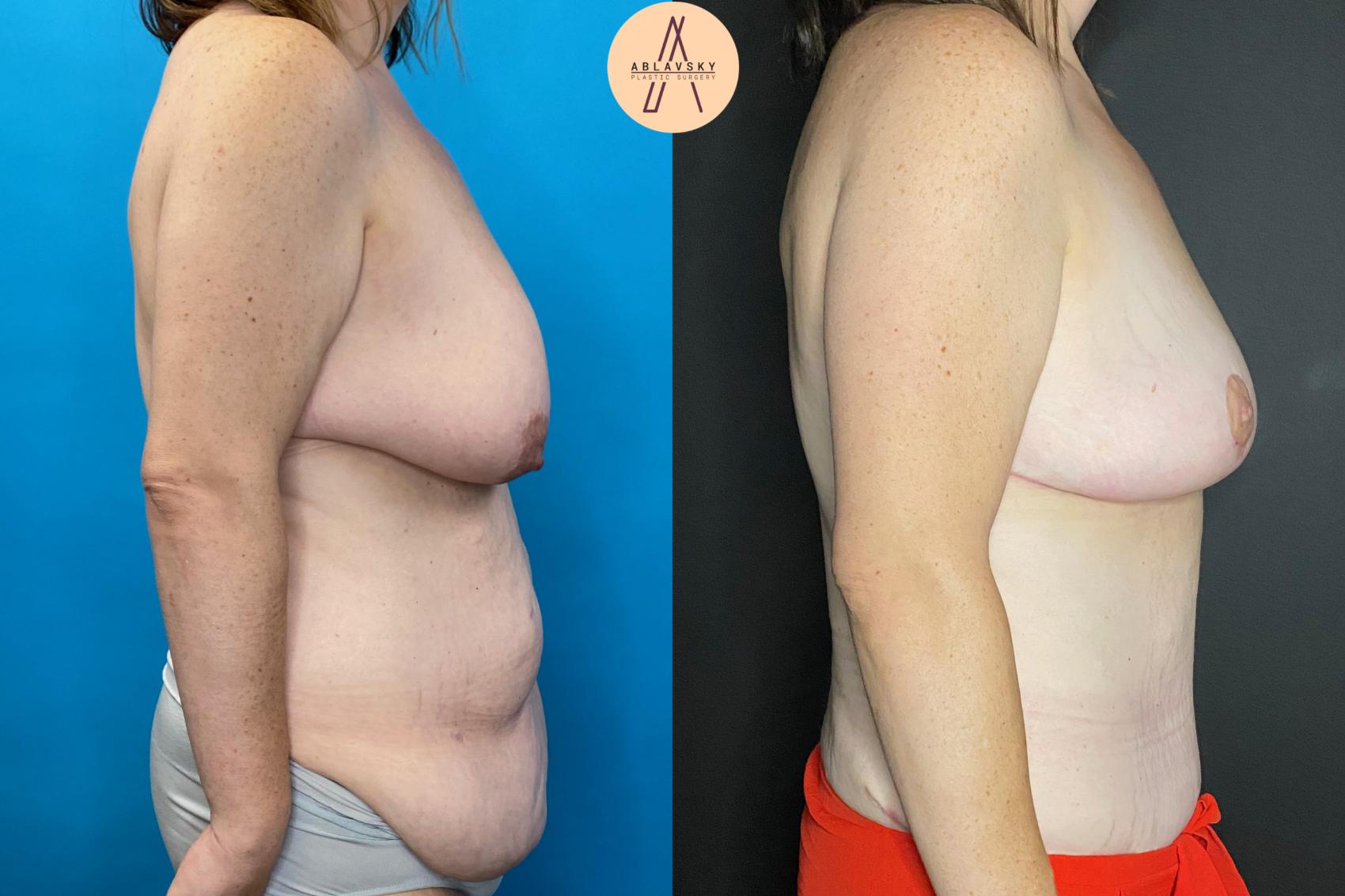 Before & After Breast Lift Case 31 Right Side View in San Antonio, Texas