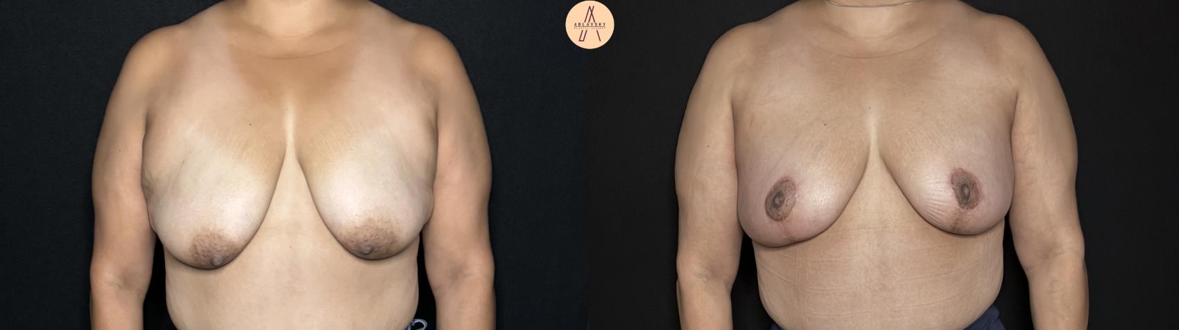 Before & After Breast Lift Case 317 Front View in San Antonio, Texas