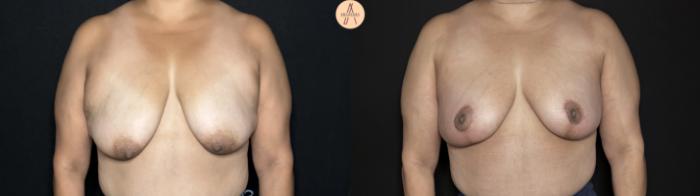 Before & After Breast Lift Case 317 Front View in San Antonio, Texas