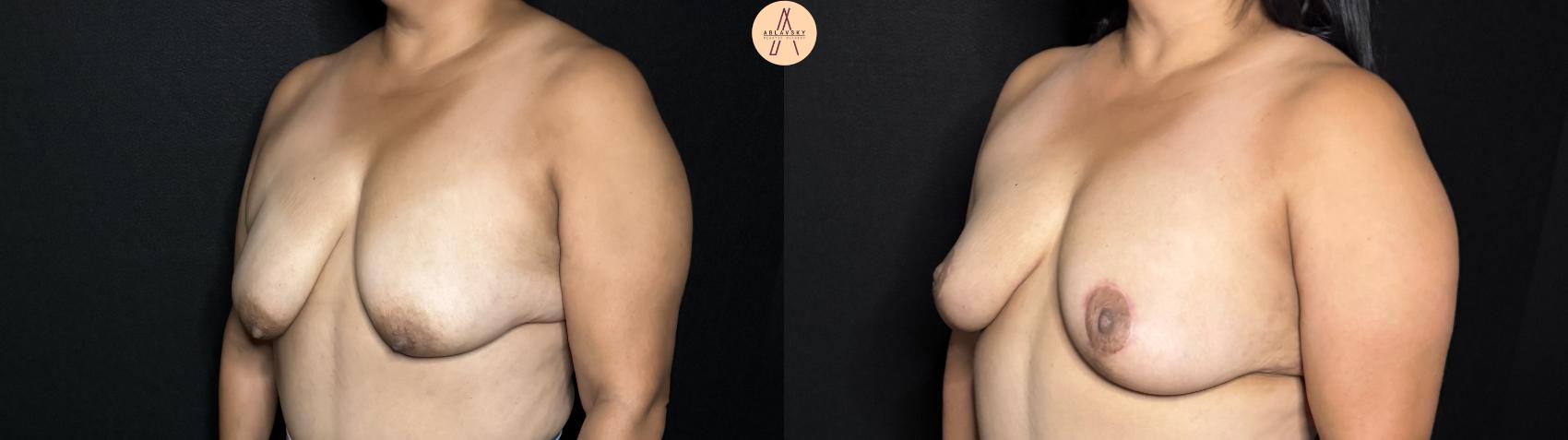 Before & After Breast Lift Case 317 Left Oblique View in San Antonio, Texas