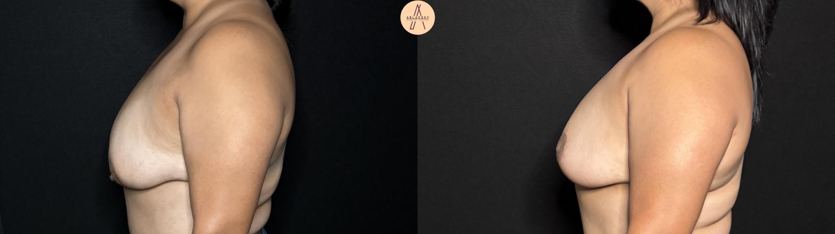 Before & After Breast Lift Case 317 Left Side View in San Antonio, Texas