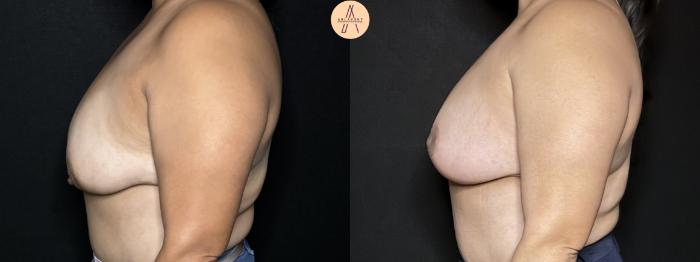 Before & After Breast Lift Case 317 Left Side View in San Antonio, Texas