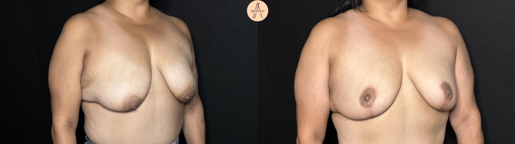 Before & After Breast Lift Case 317 Right Oblique View in San Antonio, Texas