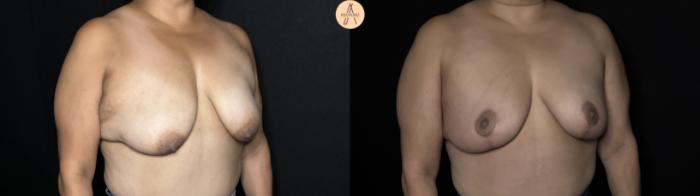 Before & After Breast Lift Case 317 Right Oblique View in San Antonio, Texas