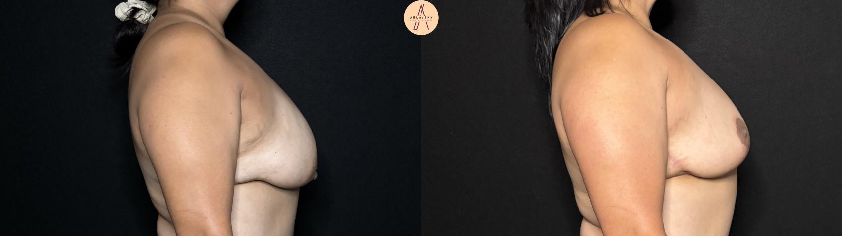 Before & After Breast Lift Case 317 Right Side View in San Antonio, Texas