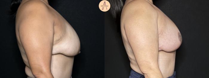 Before & After Breast Lift Case 317 Right Side View in San Antonio, Texas