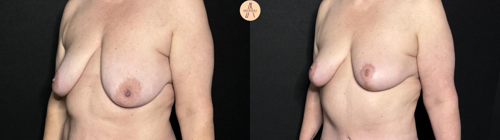 Before & After Breast Lift Case 343 Left Oblique View in San Antonio, Texas