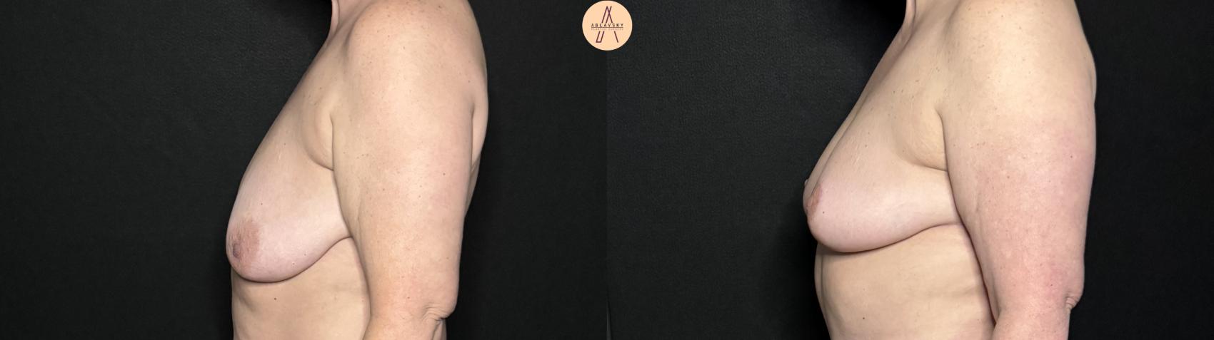 Before & After Breast Lift Case 343 Left Side View in San Antonio, Texas