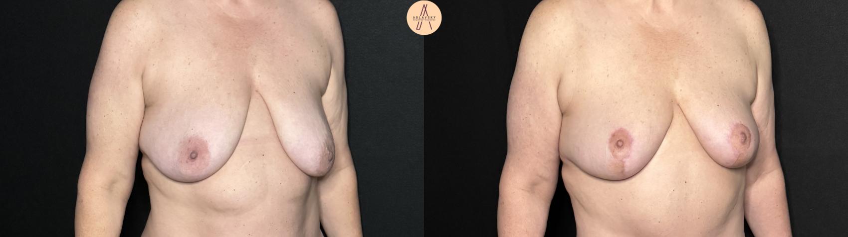 Before & After Breast Lift Case 343 Right Oblique View in San Antonio, Texas