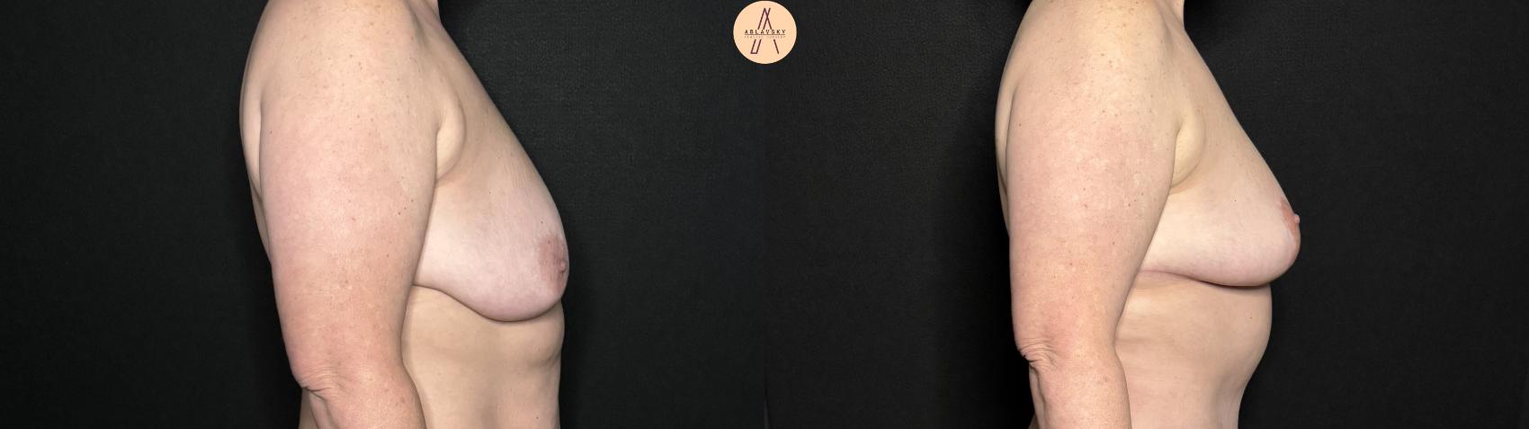 Before & After Breast Lift Case 343 Right Side View in San Antonio, Texas