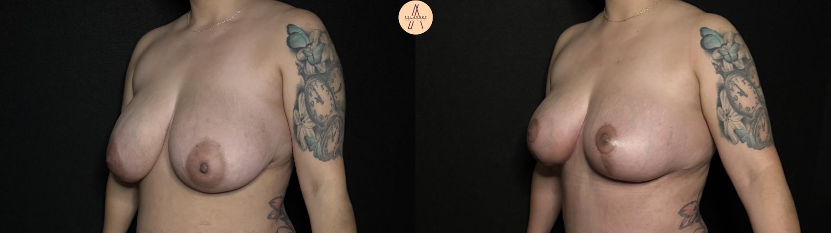 Before & After Breast Lift Case 352 Left Oblique View in San Antonio, Texas