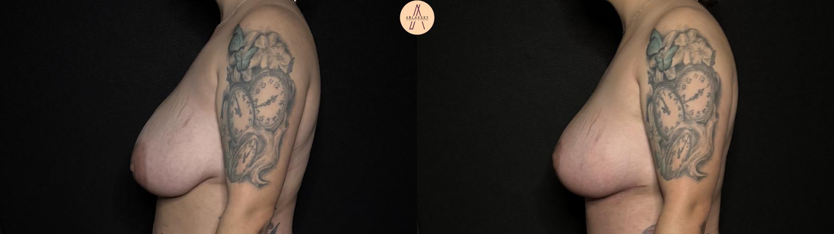Before & After Breast Lift Case 352 Left Side View in San Antonio, Texas