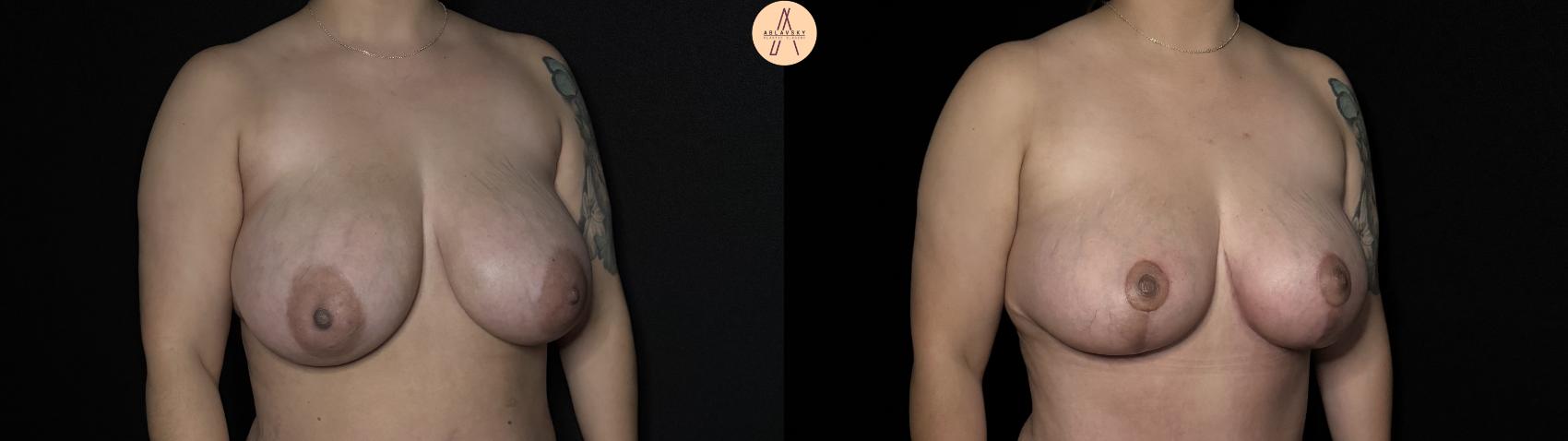 Before & After Breast Lift Case 352 Right Oblique View in San Antonio, Texas