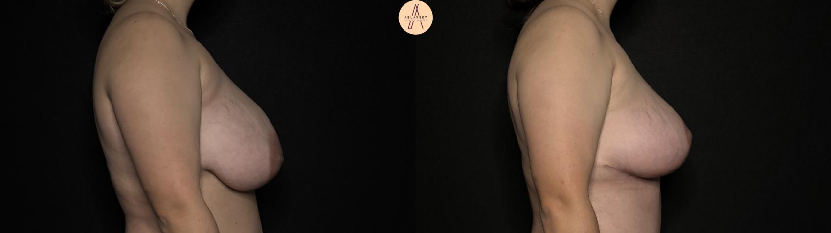 Before & After Breast Lift Case 352 Right Side View in San Antonio, Texas