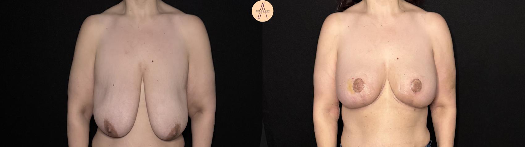 Before & After Breast Lift Case 506 Front View in San Antonio, Texas