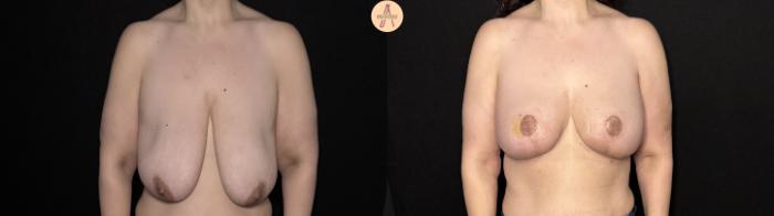 Before & After Breast Lift Case 506 Front View in San Antonio, Texas