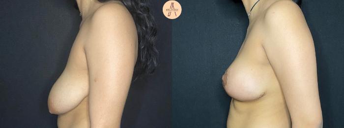 Before & After Breast Lift Case 77 Left Side View in San Antonio, Texas