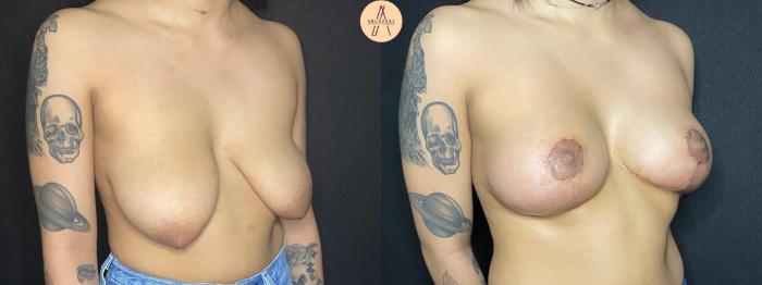 Before & After Breast Lift Case 77 Right Oblique View in San Antonio, Texas