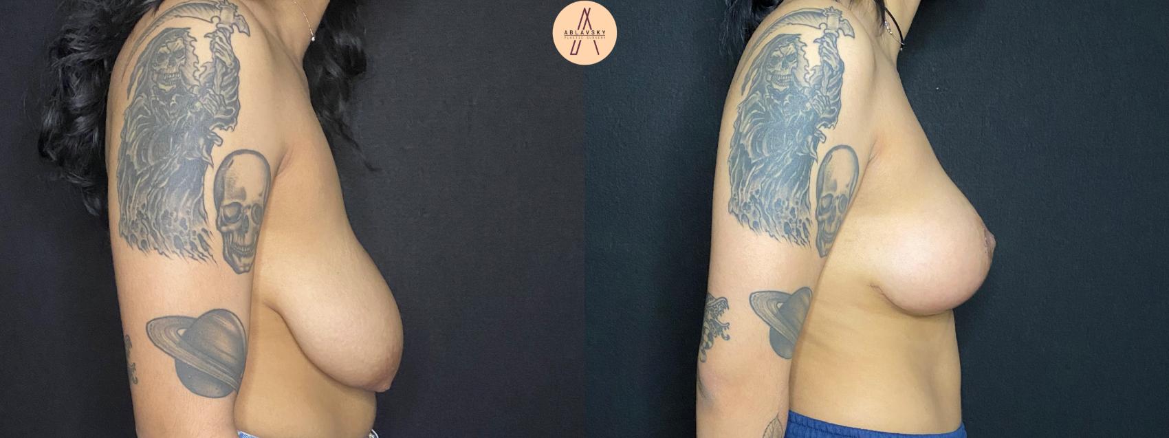Before & After Breast Lift Case 77 Right Side View in San Antonio, Texas