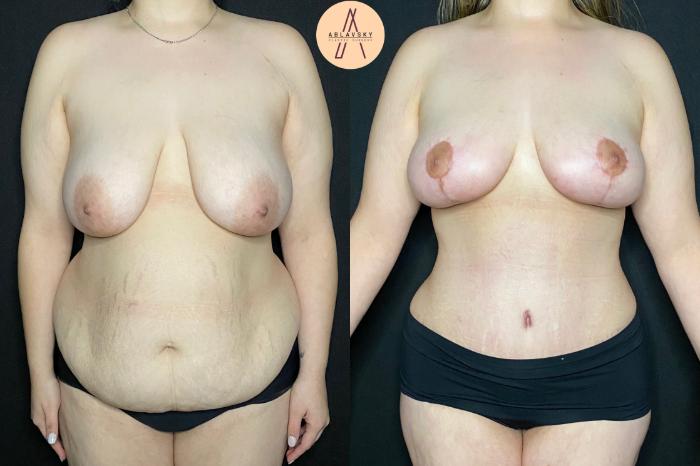 Before & After Tummy Tuck Case 84 Front View in San Antonio, Texas