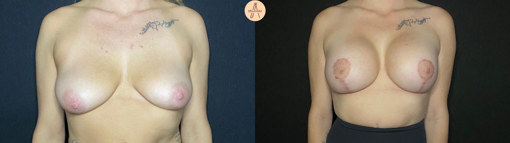 Before & After Breast Augmentation Case 96 Front View in San Antonio, Texas