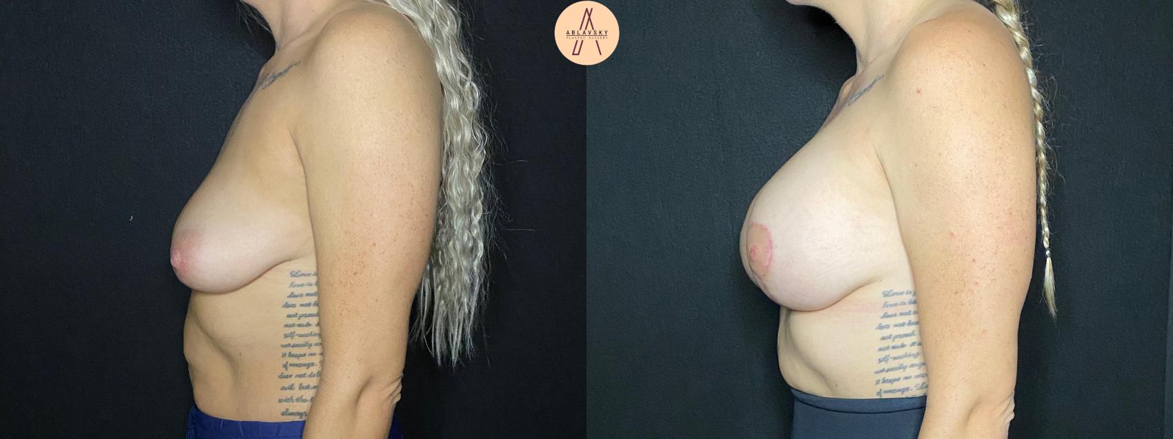 Before & After Breast Lift Case 96 Left Side View in San Antonio, Texas