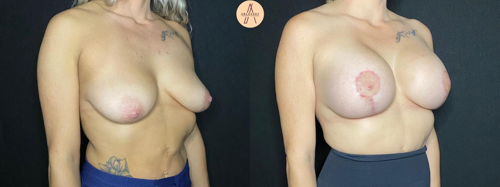 Before & After Breast Lift Case 96 Right Oblique View in San Antonio, Texas