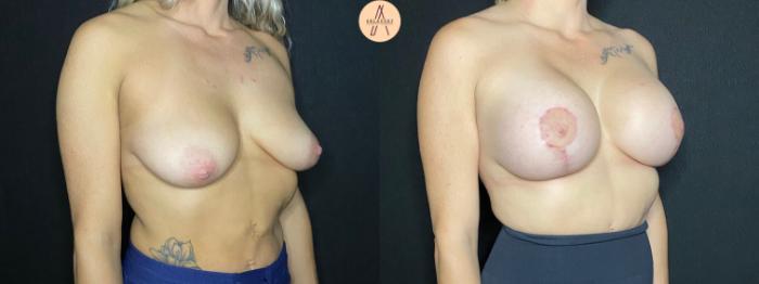 Before & After Breast Lift Case 96 Right Oblique View in San Antonio, Texas