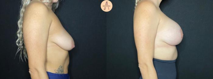 Before & After Breast Augmentation Case 96 Right Side View in San Antonio, Texas